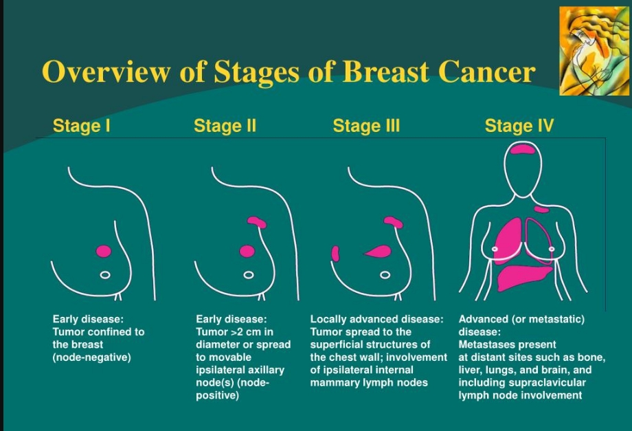 35316simple ways to prevent breast cancer.